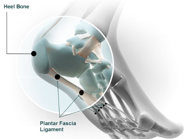 What To Know About Walking With Plantar Fasciitis